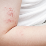 Link naar Aandacht voor gordelroos